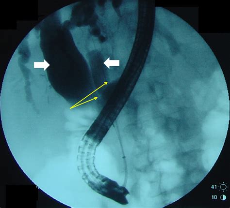 Ercp Showing Type Va Extrahepatic Bile Duct Duplication Right And Left