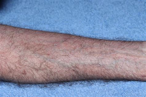 Atopic Eczema Stock Image Image Of Genetic African 222587301