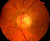 Laser Eye Treatment For Diabetics Images