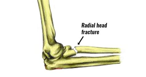 Radial Head Fracture Elbow Symptoms Causes Treatment And Rehab
