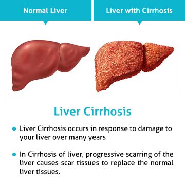 You might start to get tired, feel like you don't want to eat, and lose weight without trying. Liver Transplant in India | Liver Transplant Surgery in India