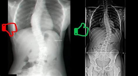 Radiografia panorâmica da coluna vertebral e sua importância