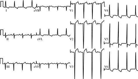 The Electrocardiographic Differential Diagnosis Of St Segment