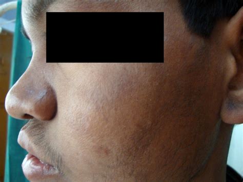 A Patient With Lepromatous Leprosy Ll Showing Saddle Nose Deformity
