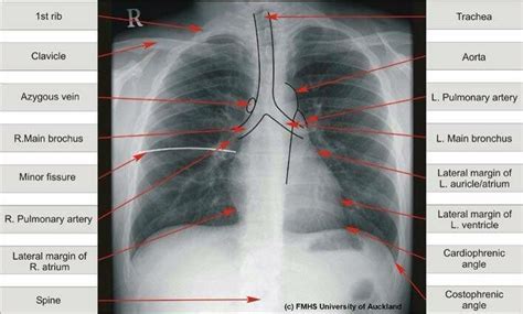 Chest Xray Radiology Radiology Student Respiratory Therapy