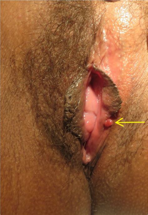 Figure 6 From Benign Lumps And Bumps Of The Vulva A Review