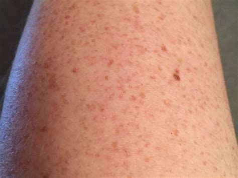 Those Bumps On Your Upper Arms Are Called Keratosis Pilaris And They