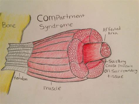 Common Running Injuries Compartment Syndrome