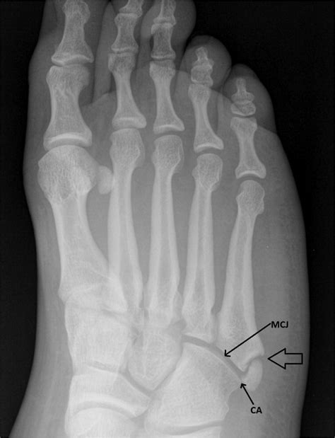 Diagnosis And Management Of Common Foot Fractures Aafp Hot Sex Picture
