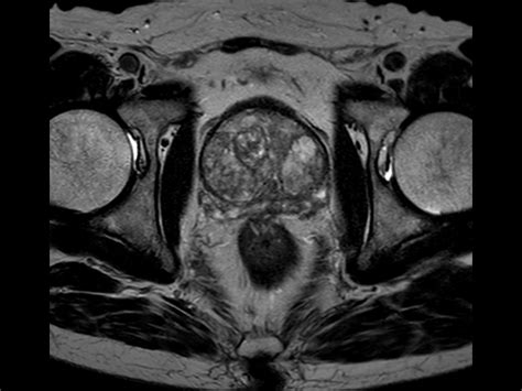 multi phase contrast enhanced prostate imaging philips mr body map