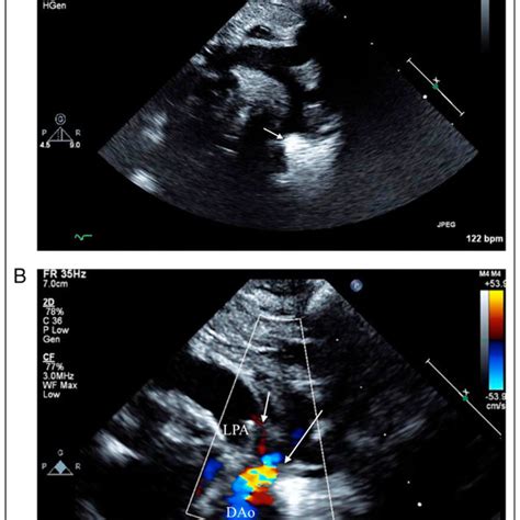 A Echocardiogram Showing The Aortic Arch There Is A Discrete Download Scientific Diagram