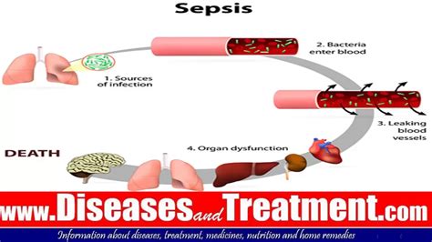 Sepsis Blood Poisoning Septicemia Causes Symptoms Diagnosis
