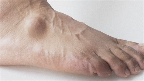 Ganglion Cyst On Foot Pictures Cause Symptoms And Treatment