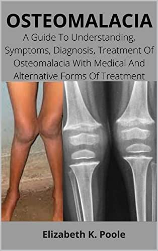 Osteomalacia A Guide To Understanding Symptoms Diagnosis Treatment