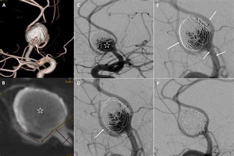 Figure 1 From Double Stent Assisted Y And X Coil Embolization Of