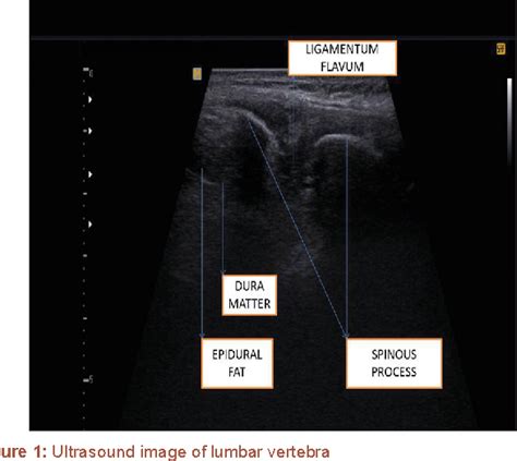 Figure 1 From Ultrasound Guided Lumbar Puncture In Emergency Department