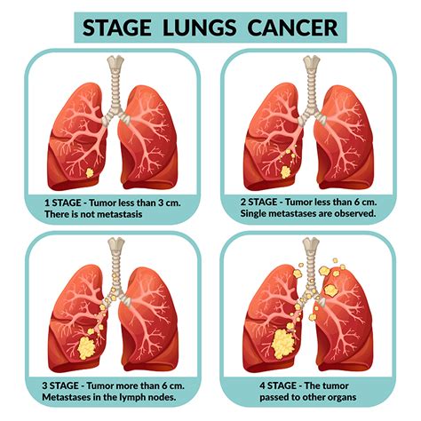 lung cancer staging prognosis infographics lung cancer treatment cell non nsclc