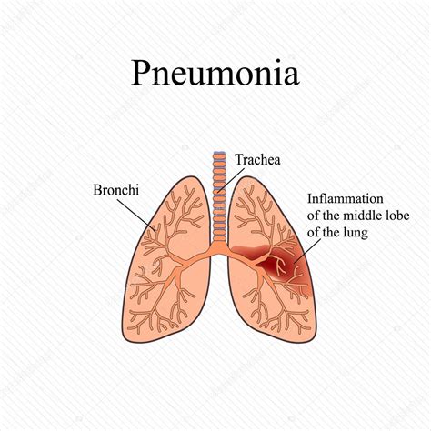 Pneumonia The Anatomical Structure Of The Human Lung
