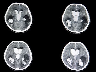 Traumatic Brain Injuries What Medical Imaging Reveals Touchstone Hot