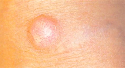 Medical Pictures Info Epidermal Cyst
