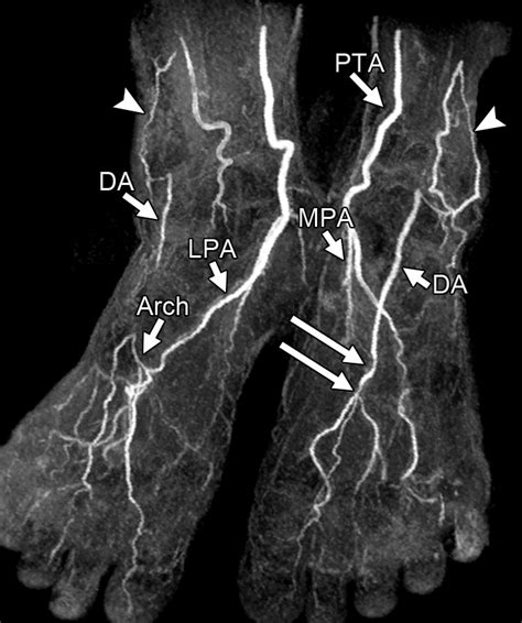 Unenhanced Mr Angiography Of The Foot Initial Experience Of Using Flow