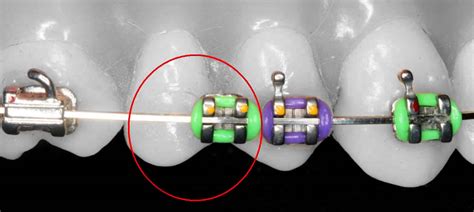 Orthodontics Australia What To Do If Your Braces Are Broken