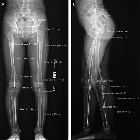 3d Modeling Of Lower Extremities With Biplanar Radiographs