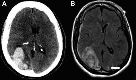 Pazopanib Associated Posterior Reversible Encephalopathy Syndrome With