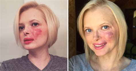 Woman Who Faced Years Of Bullying Finally Embraces Her Giant Birthmark