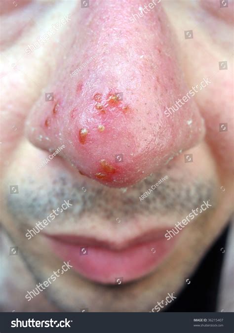 A Medical Condition Closeup Of The Common Cold Sore Virus Herpes