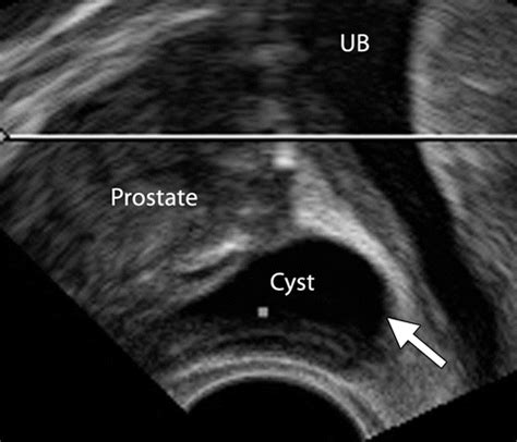 Cysts Of The Lower Male Genitourinary Tract Embryologic And Anatomic