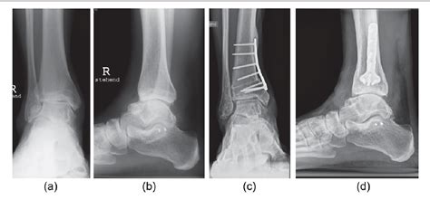 Figure 7 From The Use Of Osteotomies In The Treatment Of Asymmetric