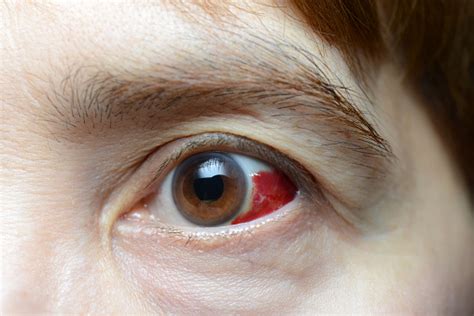 Woman With Burst Blood Vessel In Eye Closeup Stock Photo Download