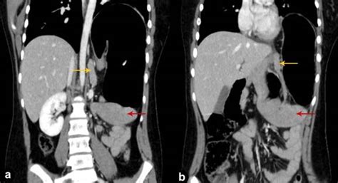 Wandering Spleen With Torsion Causing Pancreatic Volvulus And