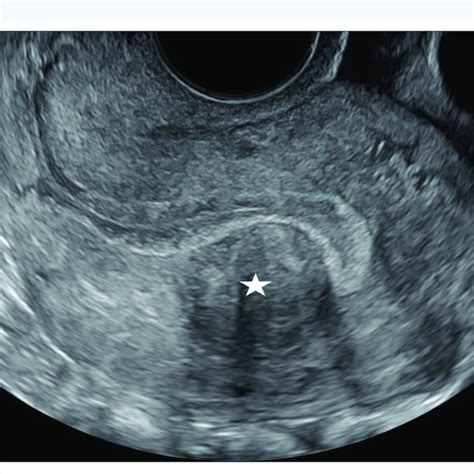 Two Dimensional 2d And Three Dimensional 3d Transvaginal Ultrasound