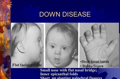 Folds epicanthal bridge researchgate nasal flat foetal c022 syndrome alcohol science library artwork. Flat Nasal Bridge And Epicanthal Folds / Chromosomal Diseases Biochemistry Medbullets Step 1 ...