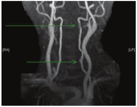 Postpartum Vertebral Artery Dissection Bmj Case Reports My XXX Hot Girl