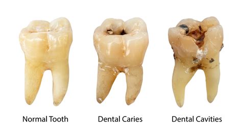 What Do Tooth Cavities Look Like
