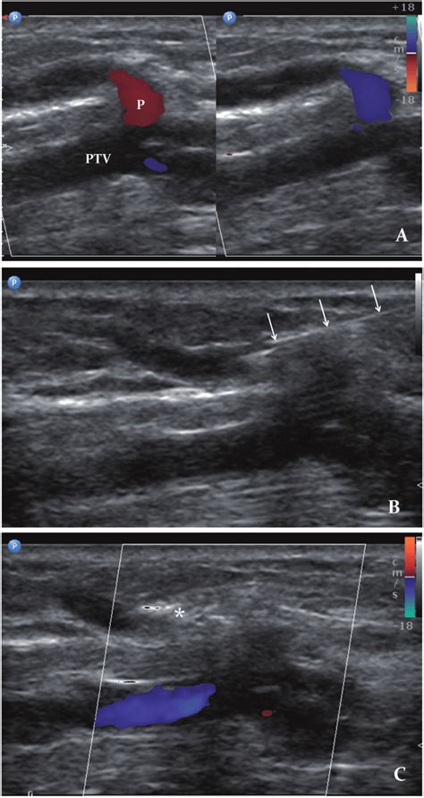 A Incompetent Perforator P From Posterior Tibial Vein Ptv Showing