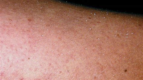 Dry Patches On Skin Not Itchy Or Red Atopic Dermatitis Symptoms