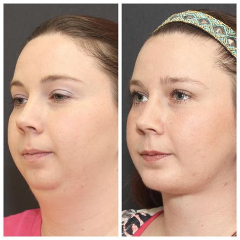Chin Implants Before And After Patient 01 Nayak Plastic Surgery