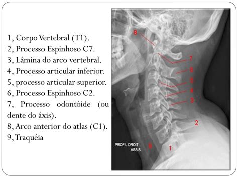 Anatomia Radiológica Da Coluna Vertebral