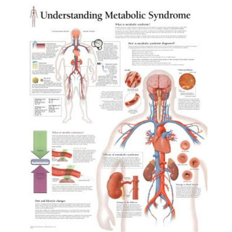 Metabolic Syndrome Educational Chart Poster 22x28