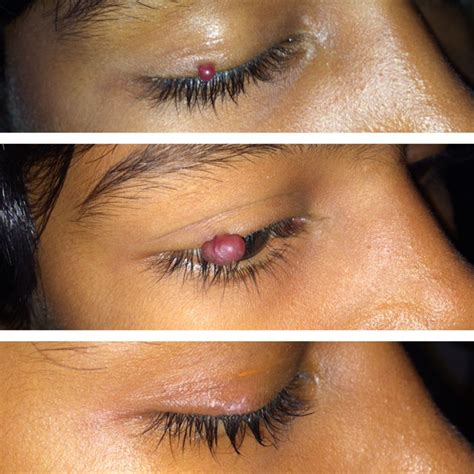 Rapidly Enlarging Acquired Capillary Hemangioma Of The Eyelid Bmj