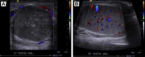 Testicular Torsion Ultrasound Findings