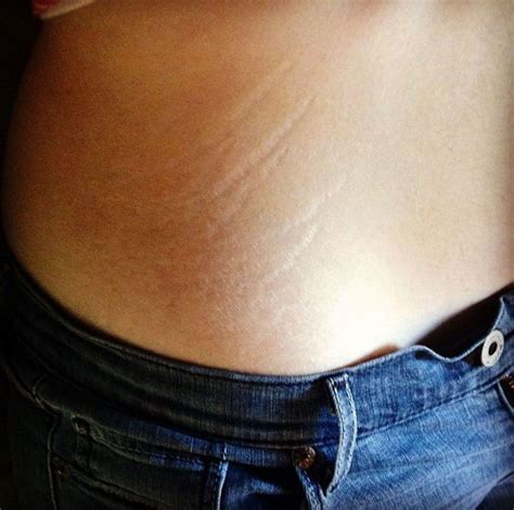 Girls Everywhere Are Embracing Their Stretch Marks In Amazing New Viral