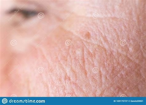 Age Spots On The Face Of A Woman With Dry Skin And Wrinkles Background