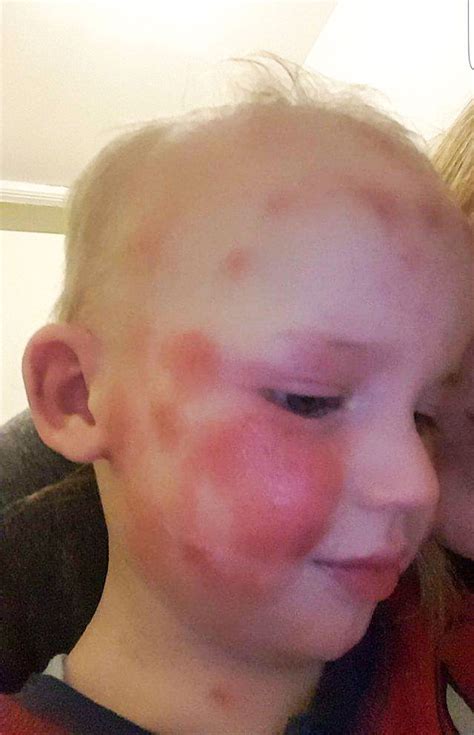 Eczema Toddler Suffers So Badly It Looks Like He Has Been Bashed Kidspot