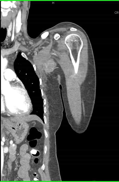 Left Axillary Mass Due To Breast Cancer Seen In Multiple Perspectives