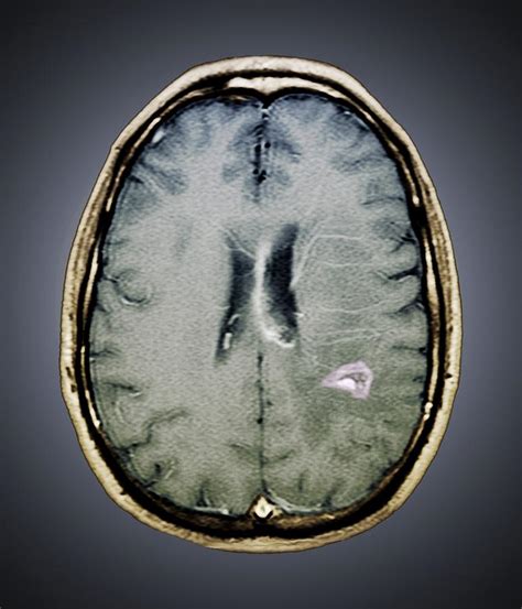 Tapeworm Cyst In The Brain Mri Scan Photograph By Zephyr